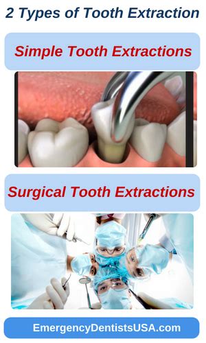 emergency dentist near me|same day tooth extraction near me.